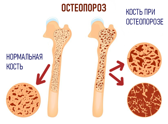 Почему у пожилых людей возникают переломы костей?